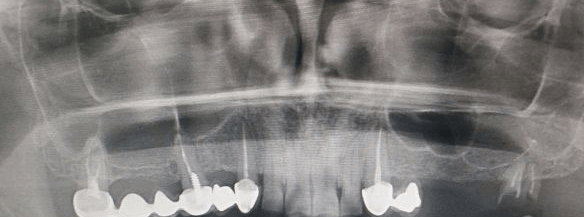 о ортопантомограмме зубов